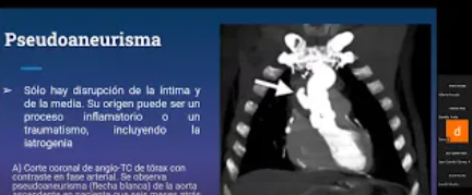 Monografía: Tórax  AngioTC Torácica
