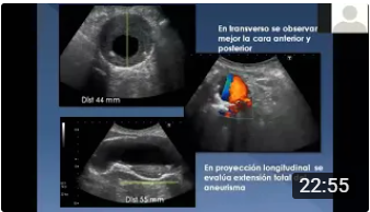 Aorta Abdominal