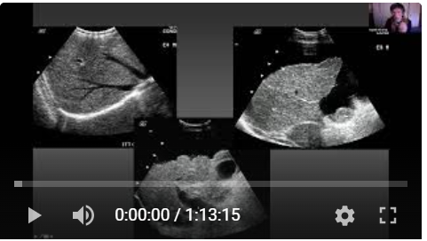 Ecografía y doppler en la hepatopatía crónica