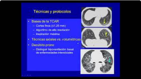 Enfermedades intersticiales pulmonares