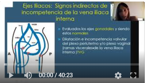 Síndrome congestión pélvica PARTE II