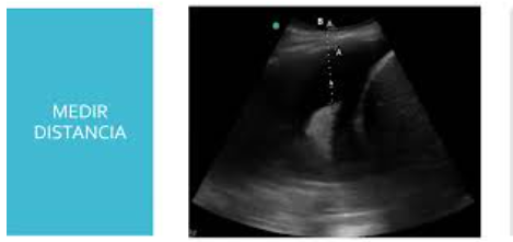 Marcación ecográfica Toracocentesis y paracentesis