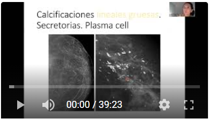 Mama Microcalcificaciones mamarias