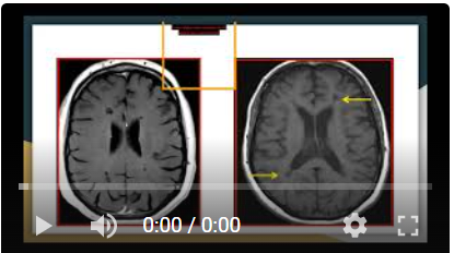 Neuro Actualización Esclerosis Múltiple