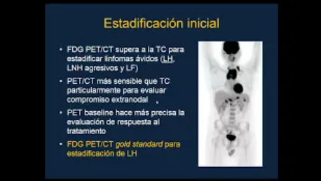 Ateneo Oncoimagenes Casos de Linforma con Pet TC